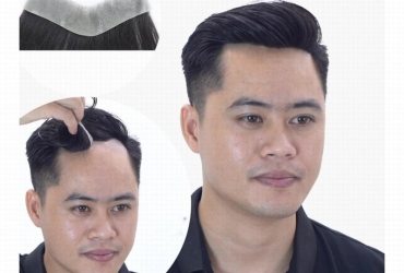 Giải pháp “ cứu cánh “ hiệu quả cho phái mạnh khi chọn tóc giả nam hói chữ M