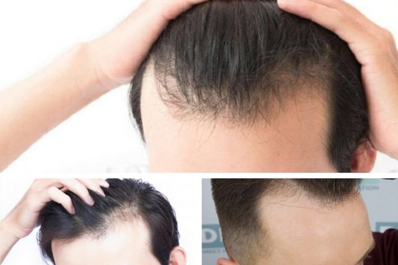 Rụng tóc, hói đầu đang là vấn đề mà nhiều đàn ông Việt Nam gặp phải