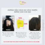 Mieng Dan Che Seo 002a Miếng dán che sẹo trên đầu
