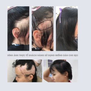 Mái Giả | Che Sẹo Trên Đầu - Ảnh 3