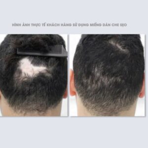 Mái Giả | Che Sẹo Trên Đầu - Ảnh 4